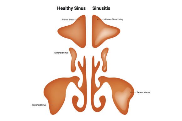 Download Healthy Sinus Sinusitis Science Design - Healthy Collection